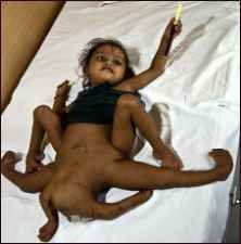 DU birth-defected baby from the Punjab